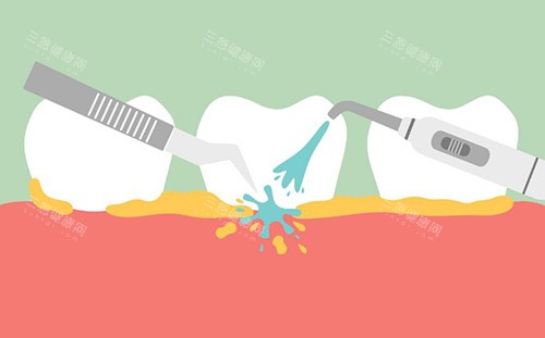牙结石洁牙卡通图