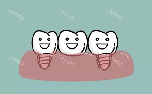 种植牙修复展示照片