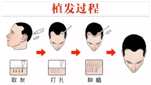 宁波初美星范医疗美容植发过程示意图