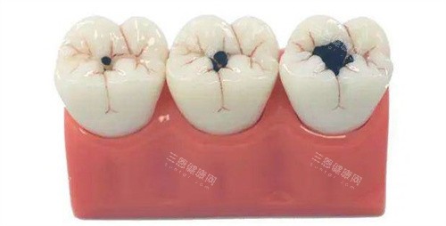 补牙的大小对比