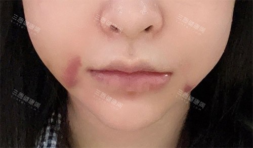 轮廓手术面部肿胀