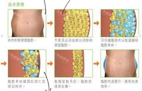 酷塑冷冻溶脂