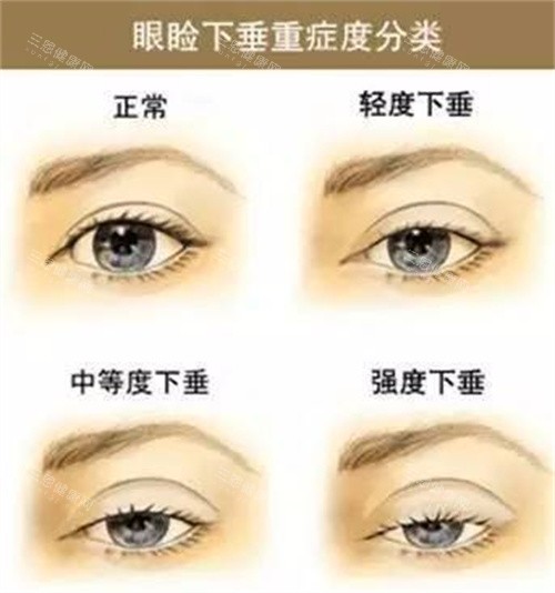 滕双燕医生双眼皮技术深度解析：5种眼型设计方案+拆线前后对比实录