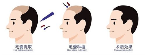 福州靓壹生医疗美容植发怎么样?擅长多种植发技术,擅长无通知发|不剃发植发口碑好