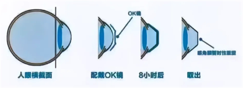角膜塑形镜8小时后变化