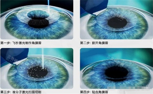 2025年遵义近视手术费用：半飞秒、全飞秒、晶体植入等价格参考