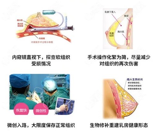 北京注射物取出丁小邦医生简介：注射物取出技术靠谱干净，坐诊医院支持官网/电话/微信多渠道预约