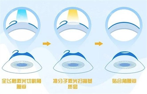 解放军总医院第一附属医院眼科2025价格表一览：近视手术9800元起、白内障手术6000元起、角膜移植术30000元起