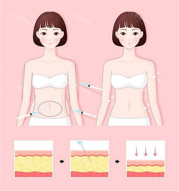 腰腹吸脂对比