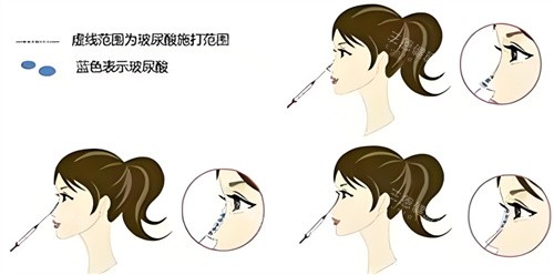 润洛薇玻尿酸是国产的吗？和进口玻尿酸比怎么样？结果能维持多久？
