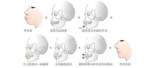 重庆正颌手术推荐医院有哪些？vs私立，医生技术、价格、修复期详解！