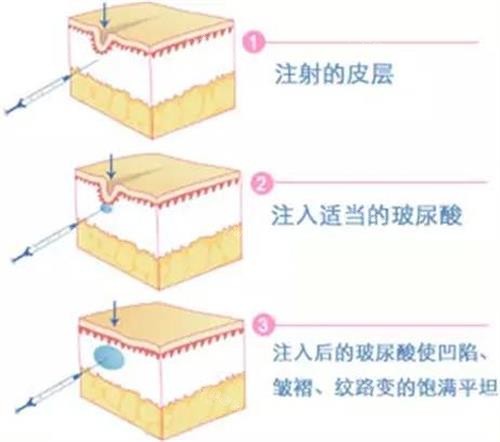 润洛薇玻尿酸优缺点有哪些？适合哪些人打？真实用户反馈分享！