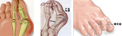 大脚骨的表现