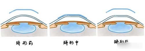 晶体植入矫正近视前中后漫画示意图