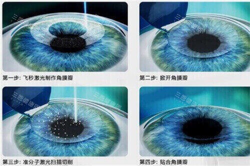 爱尔眼科收费价目表全解析：近视手术1.9万起，白内障3千~4万+，ICL晶体3.2万+
