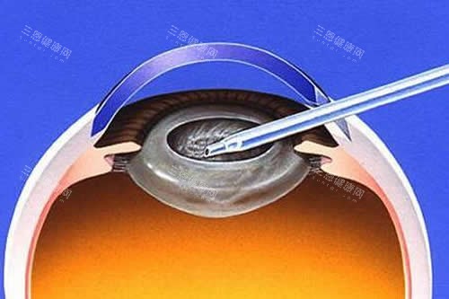 齐齐哈尔白内障免费手术政策查询，2025年这些情况或可申请免费手术！