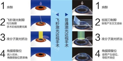 中山做近视矫正大概多少钱？激光手术15000+晶体植入30000+角膜塑形镜4800+