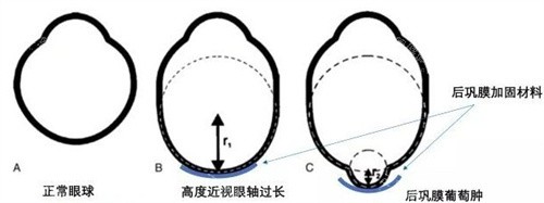 后巩膜加固术费用标准：2.5-4万元左右含手术费、材料费，部分可报销！