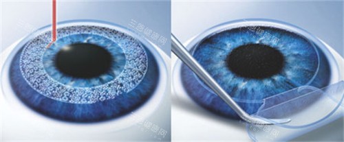北京华德眼科医院收费高吗？答案是不高！同步分享比较新华德眼科医院收费价目表，清晰了解费用