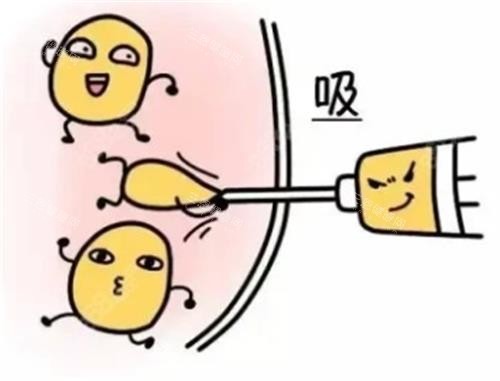 吸脂手术动画