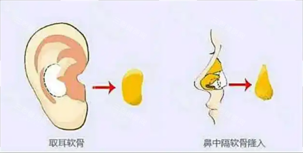 耳软骨隆鼻