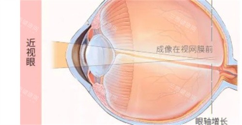 2025近视眼矫正手术要多少钱？全飞秒激光18000元起、半飞秒8000元起、ICL晶体植入术15000元起~