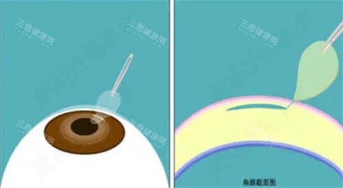 山西爱尔和太原爱尔是一家吗？挂号前必看！同在太原的山西爱尔和太原爱尔竟是这种关系！