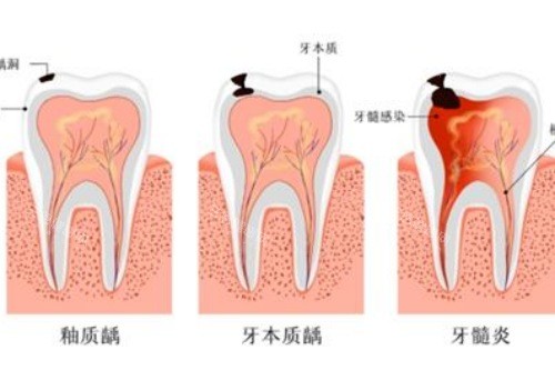 吉大口腔牙体牙髓医生推荐:显微根管选哪位?王祥柱高成功概率诊疗实录|终结牙齿反复发炎难题!
