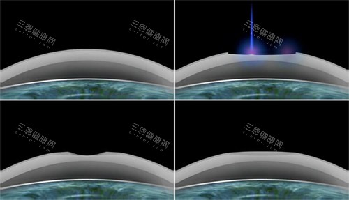 smart激光近视手术过程