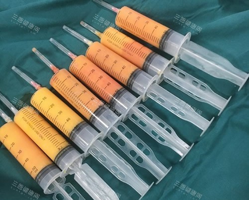 吸脂手术抽出来的脂肪照片