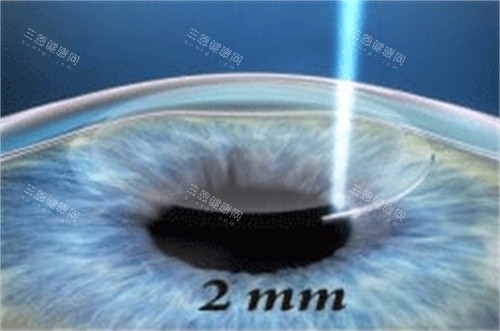 上海五官科医院眼科近视手术费用：全飞秒20000+半飞秒15000+晶体植入32000+