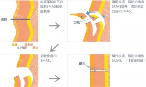 拉皮手术过程