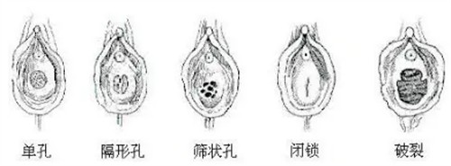做完修处缝合手术会被发现吗?我术后真实状态自然度很高,男朋友没发现哦~