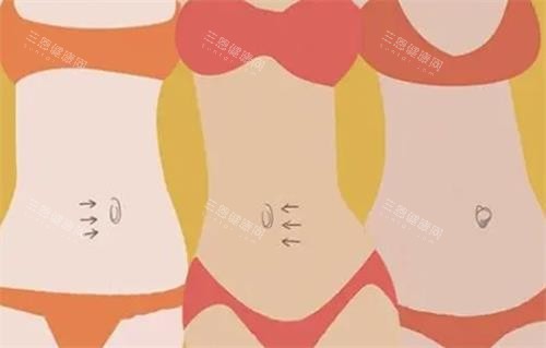 肚脐整形示意图