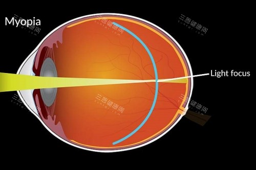 近视成像落在视网膜前 近视成像落在视网膜前