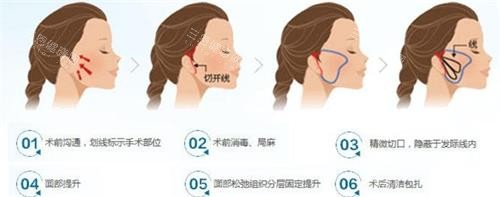 微拉美拉皮手术过程图