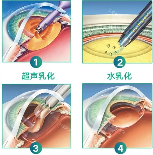 苏州白内障手术可以申请补助吗？“光明行动”进行中！揭秘哪些人群可享免费或补助手术！