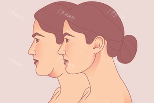 颈部拉皮变成天鹅颈