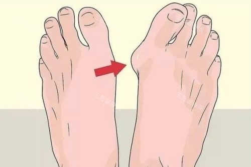 大脚骨整形前后对比图