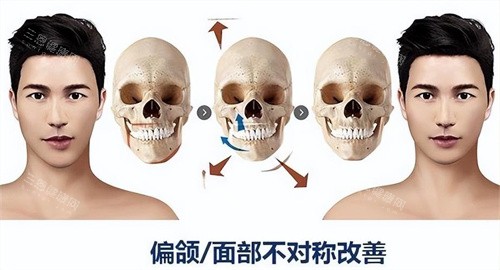 正颌手术原理与对比展示动画图