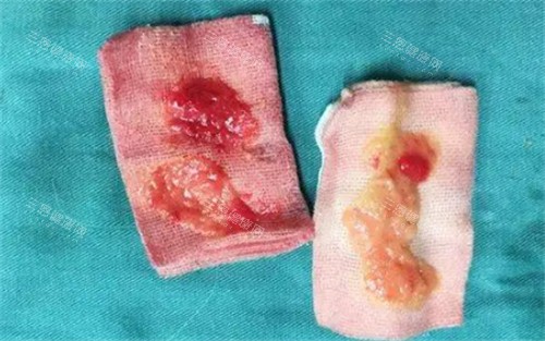 太阳穴取出的生长因子