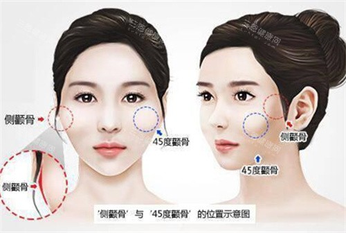 颧骨高突出演示动画图 颧骨高突出演示动画图