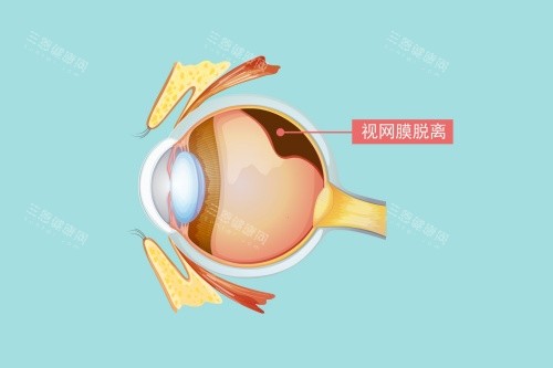 视网膜脱落图片展示