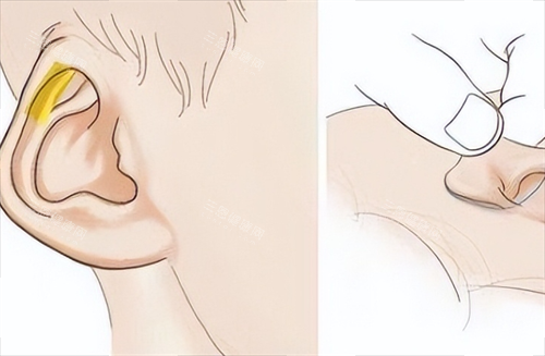 耳再造耳部畸形动画展示