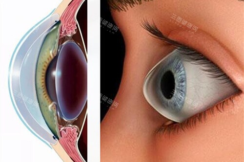 1000度近视150度散光适合什么手术？ICL、LASIK、PRK全方面解析：如何安心又有效地矫正！