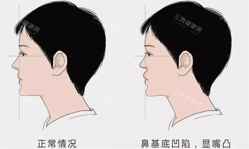 鼻基底凹陷填充