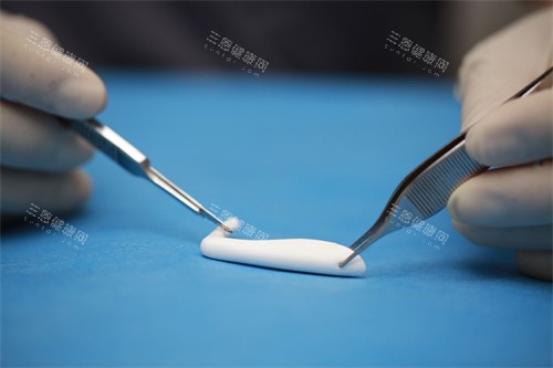 隆鼻手术中使用的膨体
