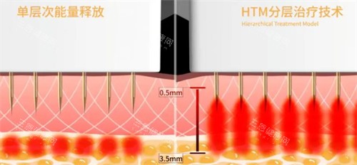 黄金微针技术介绍