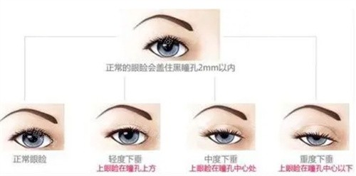 眼睑下垂程度