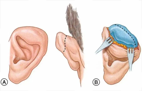 耳再造动画手术过程